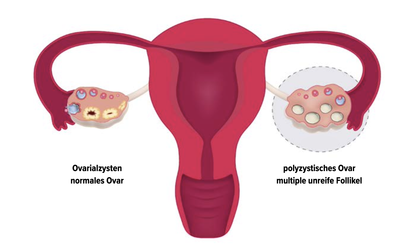 Artikel Hyperandrogenämie und „frozen ovary“